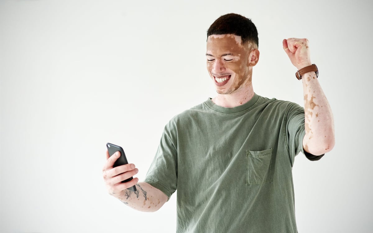Joven satisfecho con el camuflaje de vitiligo